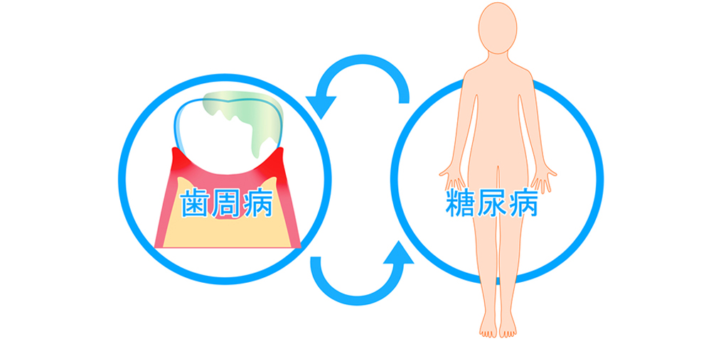 歯周病と糖尿病の深い相互関係｜血糖コントロールに影響する理由とは